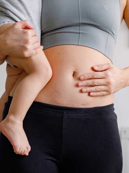 Γέννα με Καισαρική Τομή & Πότε Επανέρχεται το Σώμα