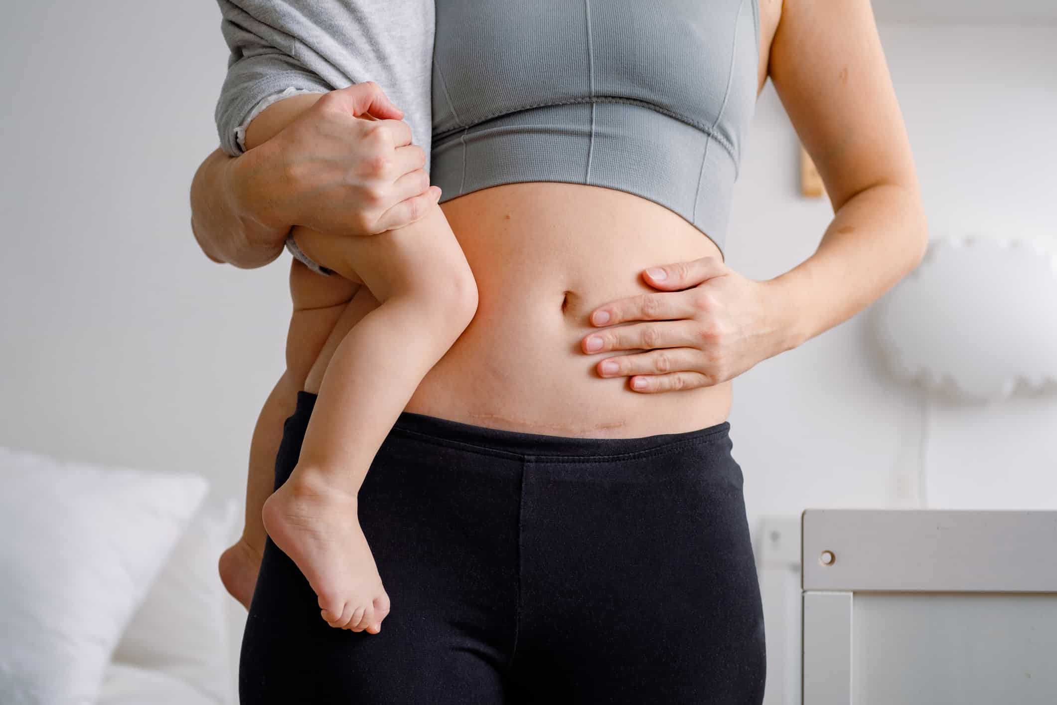 Γέννα με Καισαρική Τομή & Πότε Επανέρχεται το Σώμα